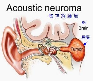 111acoustic-neuroma-300x260.jpg