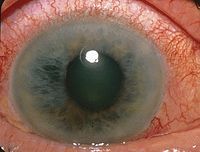 Closure-glaucoma.jpg