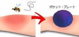 虫刺され.jpg