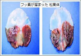 Fluoride-is-a-poison-it-destroys-your-pineal-gland-brain.jpg