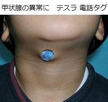 甲状腺の異常に、テスラ 電話タグ
