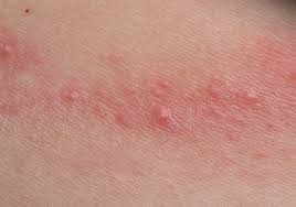 rashes.jpg